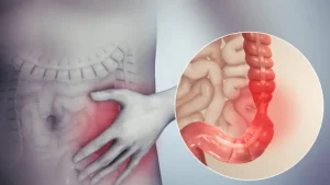 Maladies du côlon