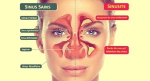 Maladies allergiques
