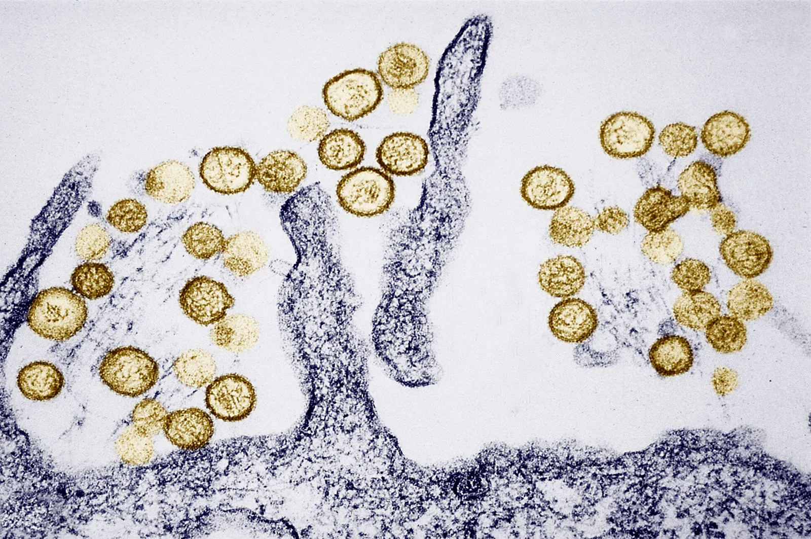 Hantavirus : compréhension, transmission, impact mondial et enjeux de santé